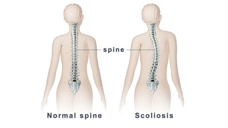 درمان بیماری اسکولیوز از طریق ورزش